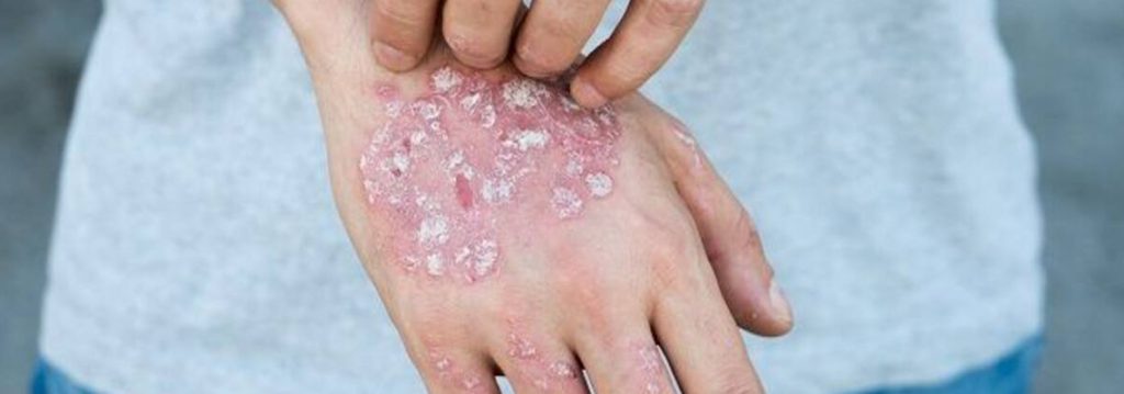 Les traitements médicamenteux pour soigner l’eczéma